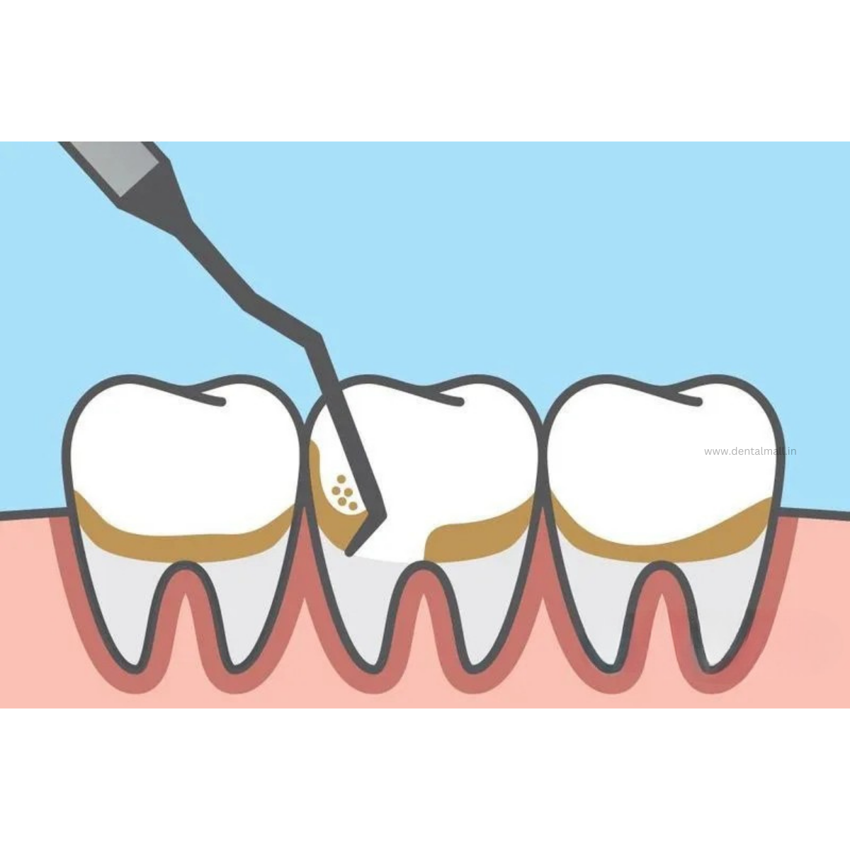 Gracey Curette Kit Set of 7 Gold TiN Coated Tips and Handle Cut Pattern #GCGK7CH