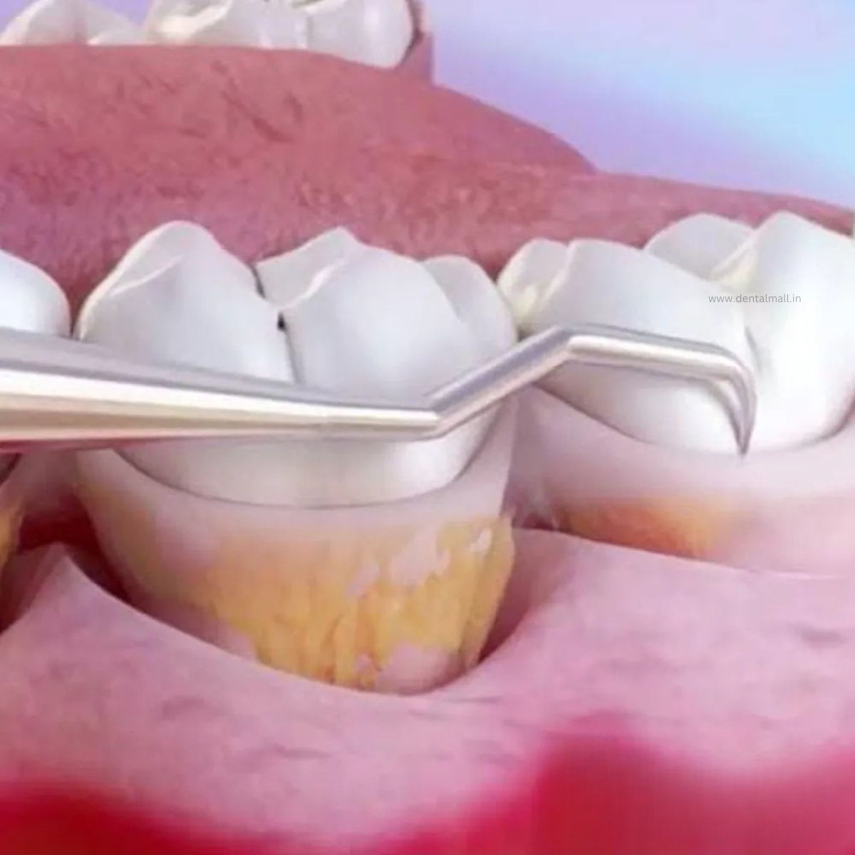 Gracey Curette Kit - Set of 7 (Blue TiN Coated Tips & Cut Handle Pattern) #GCBK7CH