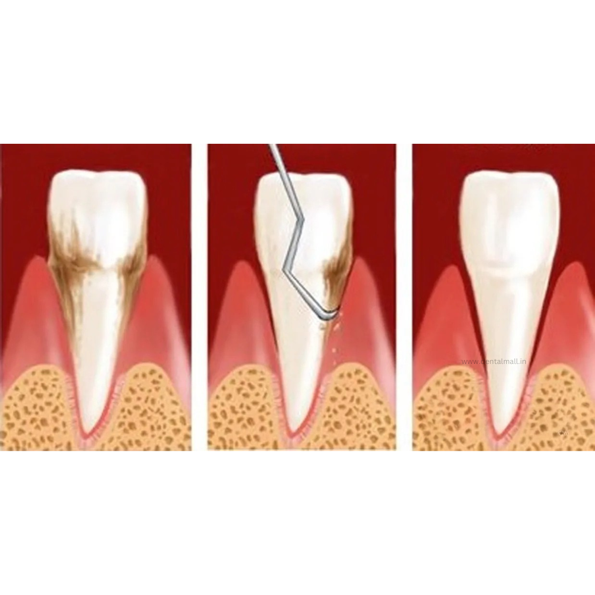 Gracey Curette Kit - Set of 7 (Blue TiN Coated Tips & Cut Handle Pattern) #GCBK7CH