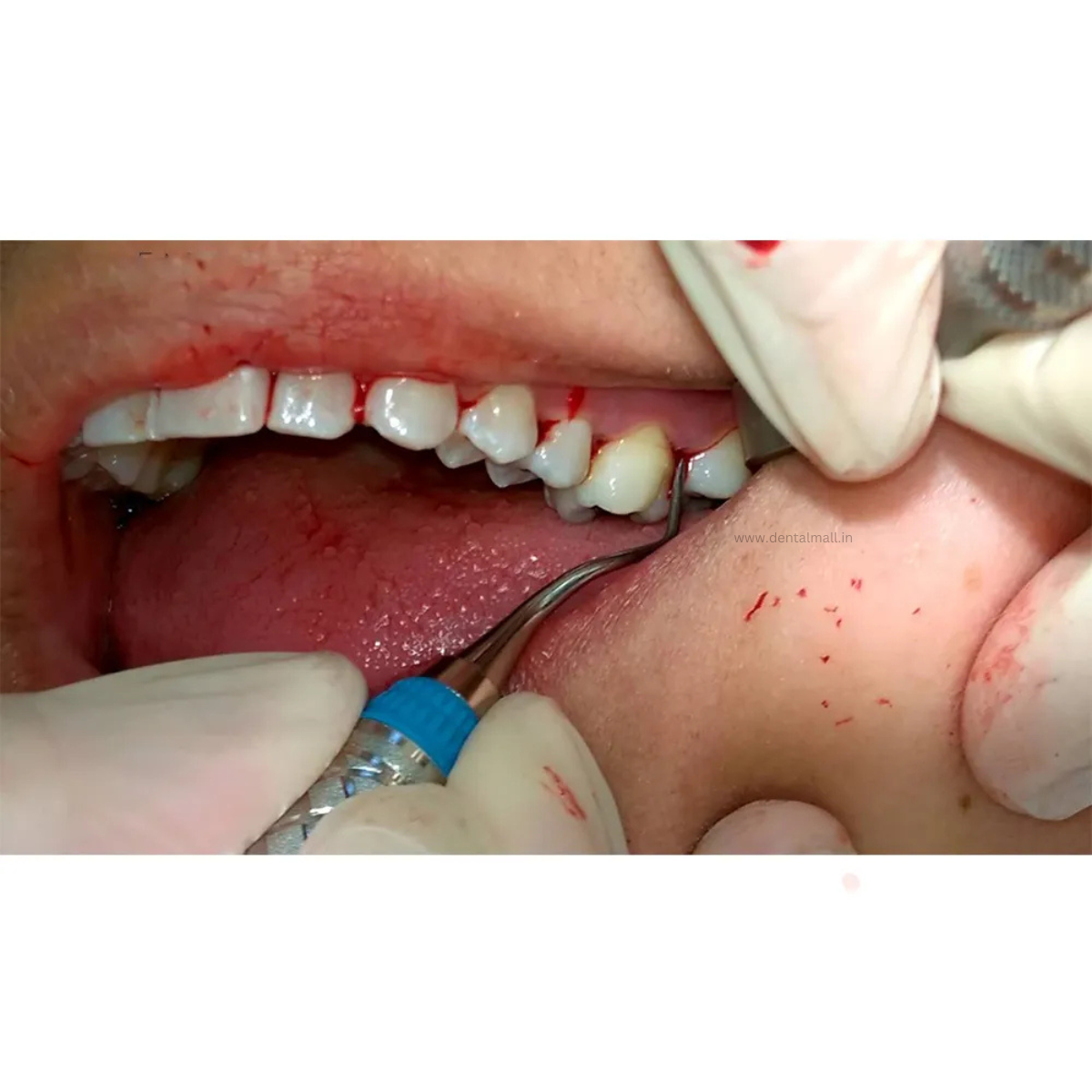 Gracey Curette Kit Set of 7 Gold TiN Coated Tips and Handle Cut Pattern #GCGK7CH