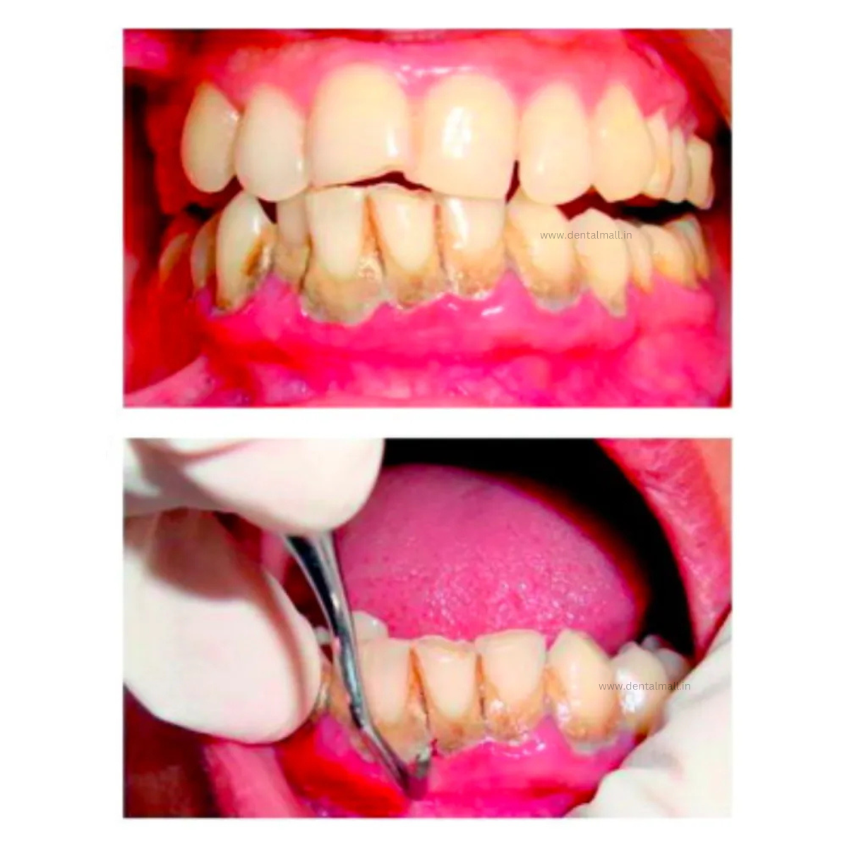 Gracey Curette Kit - Set of 7 (Blue TiN Coated Tips & Cut Handle Pattern) #GCBK7CH