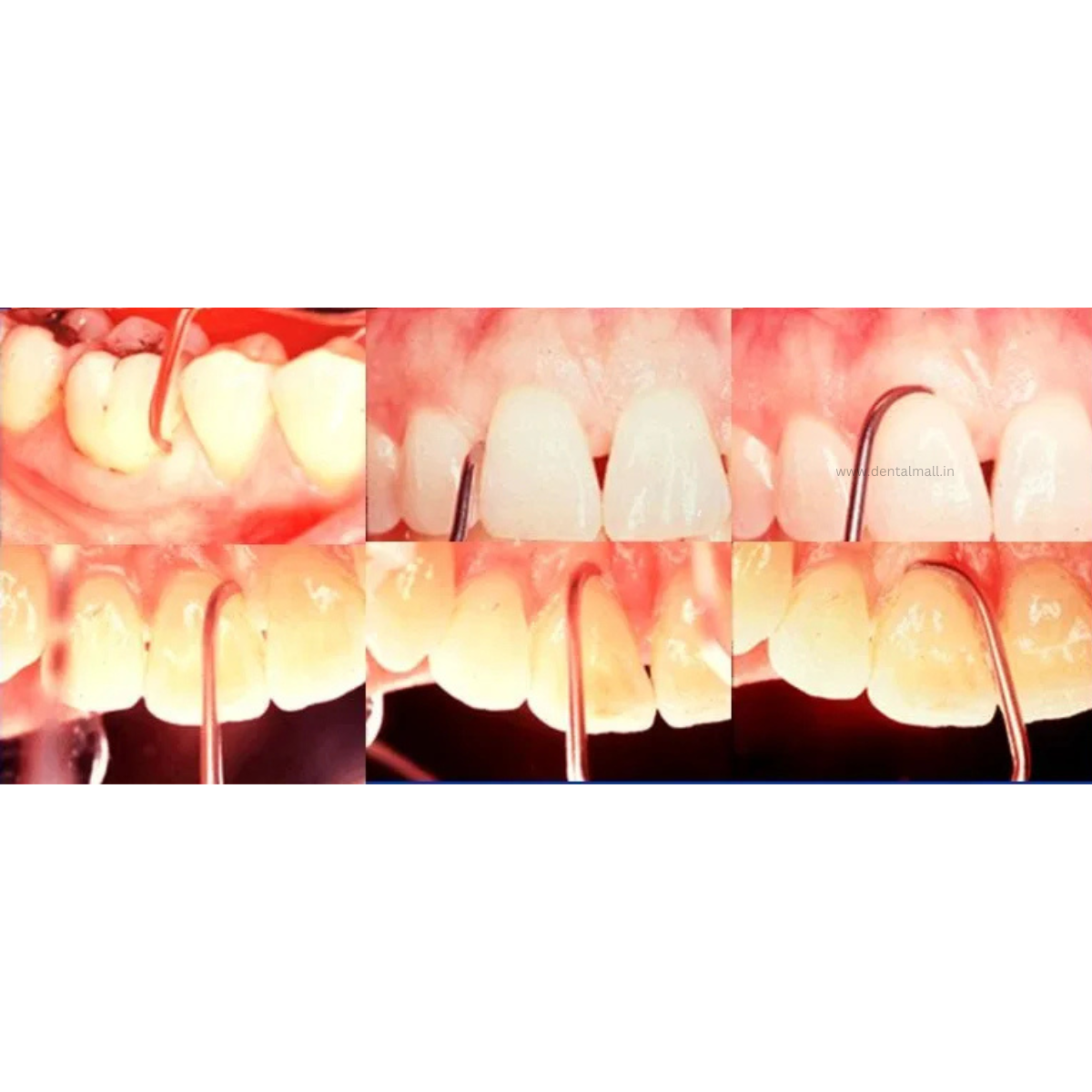 Gracey Curette Kit - Set of 7 (Blue TiN Coated Tips & Cut Handle Pattern) #GCBK7CH